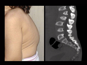 Patients-showing-thoracolumbar-kyphosis-and-gibbus-in-first-months-of-life