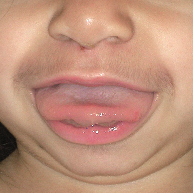 ocular manifestations of mucopolysacchridosis Background mucopolysaccharidosis iva (mps iva) is a rare lysosomal storage disorder caused by n-acetylgalactosamine-6-sulfatase deficiency, which catalyzes a step in the catabolism of glycosaminoglycans, keratan sulfate and chondroitin-6-sulfatethis disease has a variable age of onset and rate of progression. ocular manifestations of mucopolysacchridosis Background mucopolysaccharidosis iva (mps iva) is a rare lysosomal storage disorder caused by n-acetylgalactosamine-6-sulfatase deficiency, which catalyzes a step in the catabolism of glycosaminoglycans, keratan sulfate and chondroitin-6-sulfatethis disease has a variable age of onset and rate of progression.